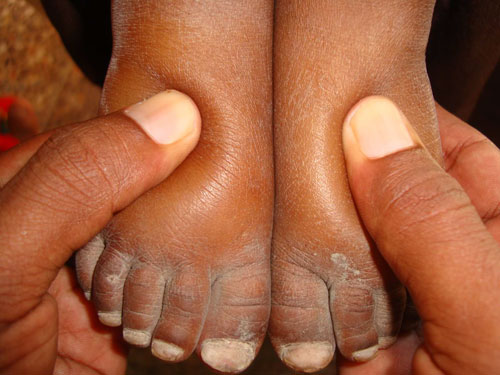 Press both feet with thumbs