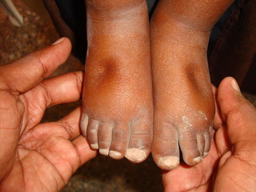 Bilateral pitting oedema observed after releasing thumbs